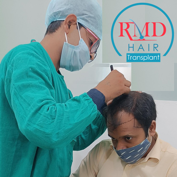 hair-transplant-in-indore