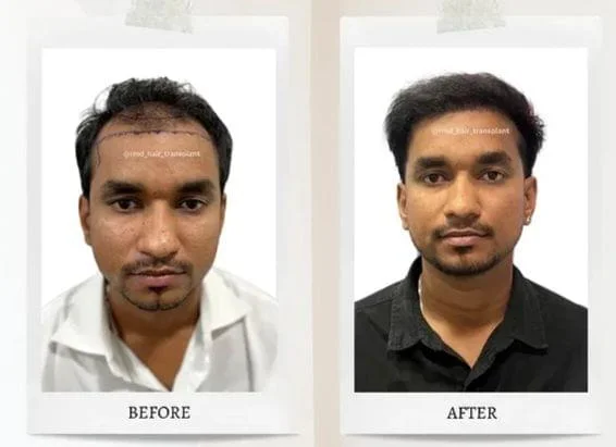 rmd_hair_transplant_14031228_190309531.jpg.bv_resized_desktop.jpg.bv-1.webp