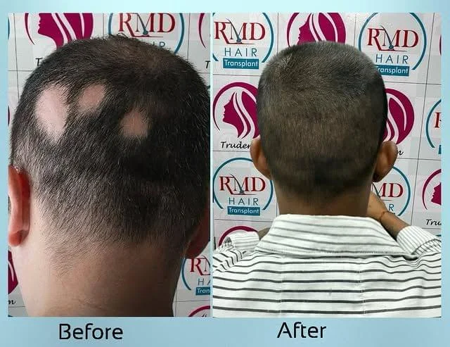 rmd_hair_transplant_14031228_190323753-1.jpg.bv_resized_desktop.jpg.bv-1.webp