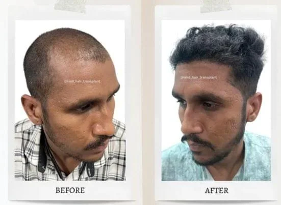 rmd_hair_transplant_14031228_190325919.jpg.bv_resized_desktop.jpg.bv_.webp
