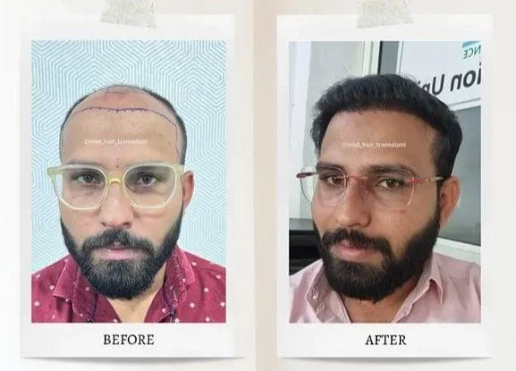 rmd_hair_transplant_14031228_190344947.jpg.bv_resized_desktop.jpg.bv-1.webp