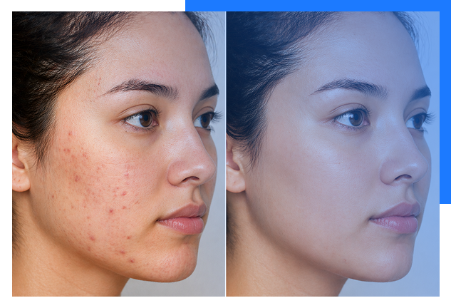 Acne Treatment Bhopal