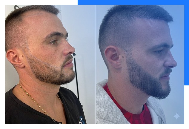 Beard Hair Transplant 4