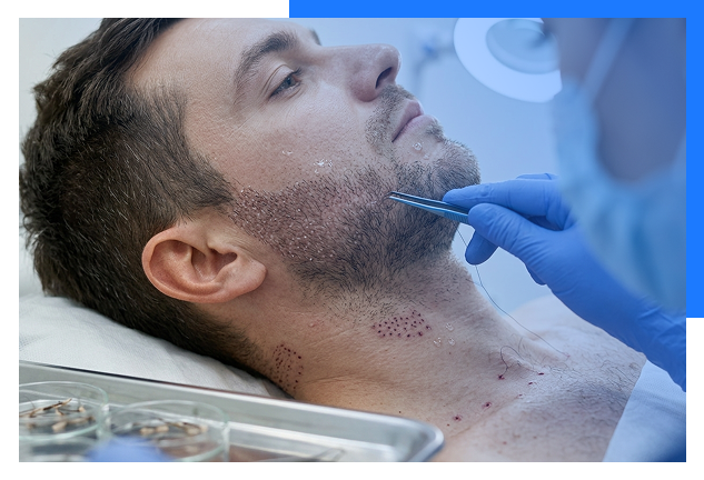 Beard Hair Transplant Bhopal