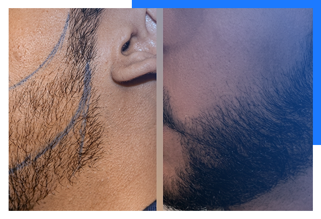Beard Hair Transplant