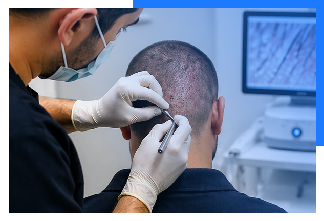 FUE Hair Transplant In Indore