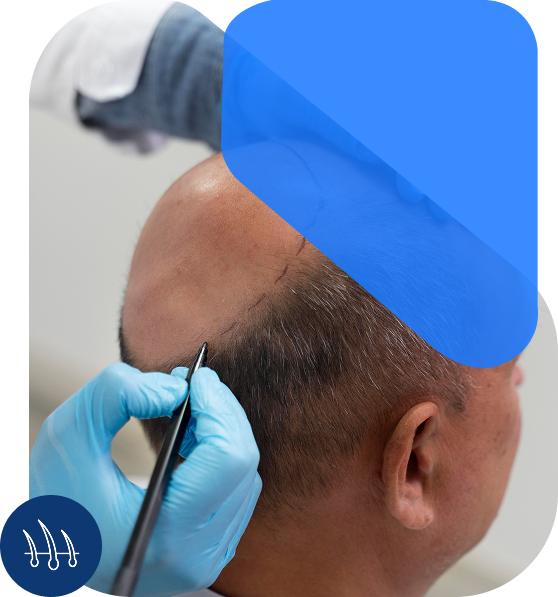 Hair Transplant In Indore