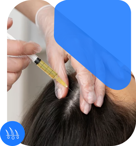 PRP Therapy For Hair Loss In Indore