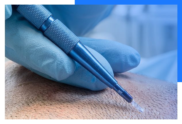 Sapphire Hair Transplant