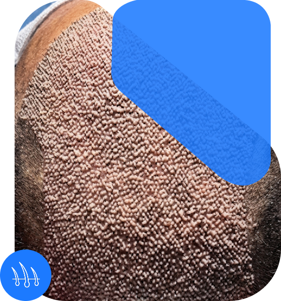 The Ultimate Hair Transplant Solution  Sapphire DHT In Indore