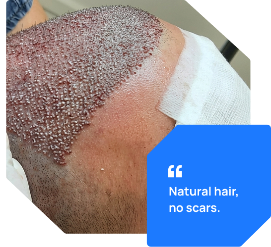 Who Is A Good Candidate For FUE