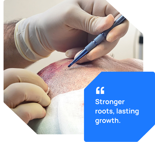 Why Choose DHT Hair Transplant In Indore