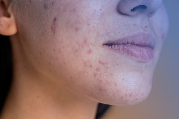 Acne Treatment