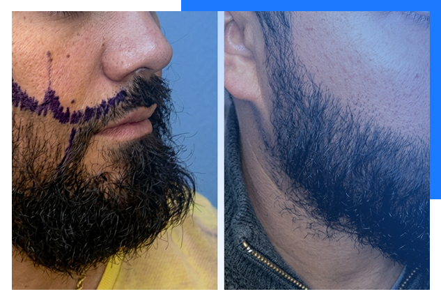 Dht Eyebrows Transplant