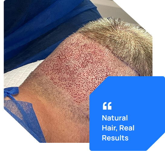 Fue Hair Transplant