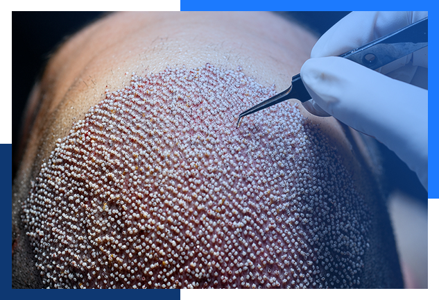 Prp Therapy For Hair Loss