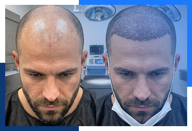 Sapphire Dht Combinations Hair Transplant